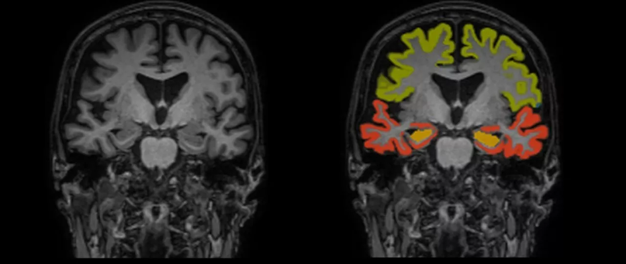 Dementia MRI with segmentation img#1